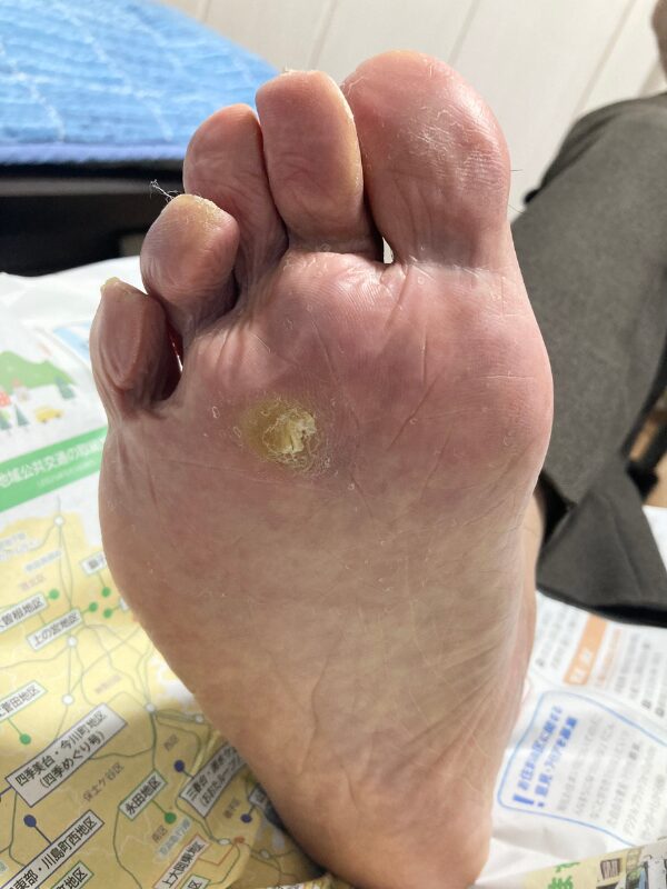 魚の目症例画像|都筑区福祉ネイル