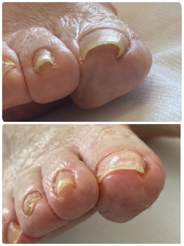 巻き爪ケア|症例画像