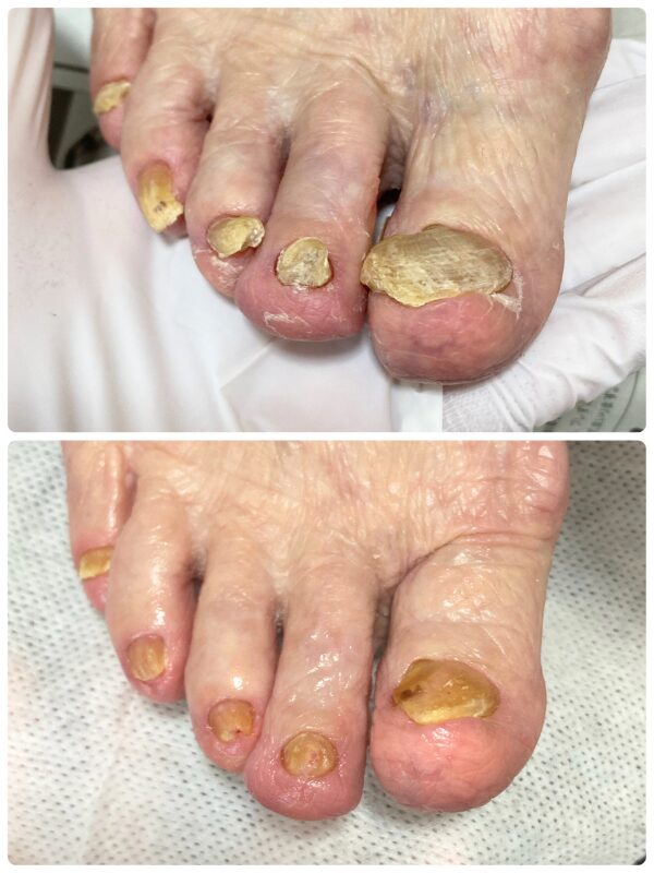肥厚爪|症例画像