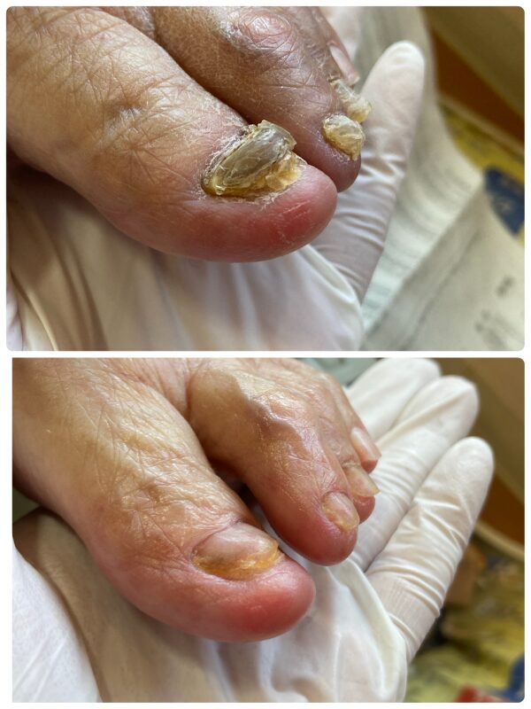 肥厚爪|症例画像