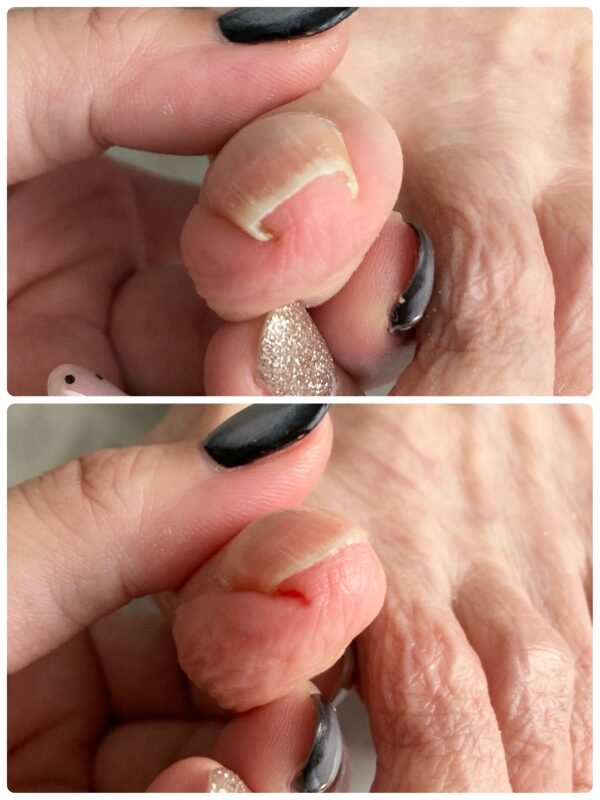 高齢者爪切り|症例画像