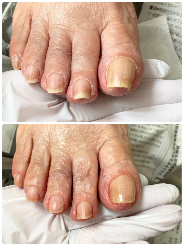 高齢者爪切り|症例画像