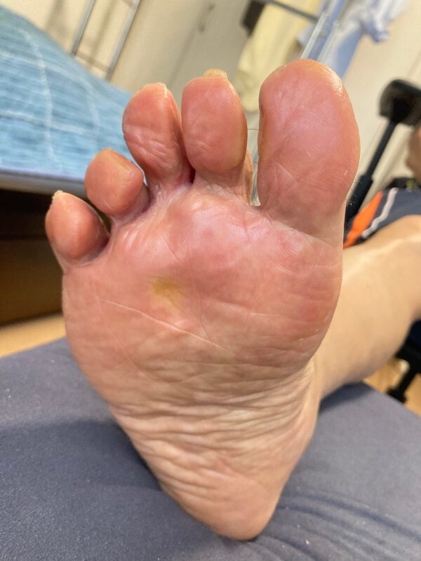 魚の目角質ケア|症例画像