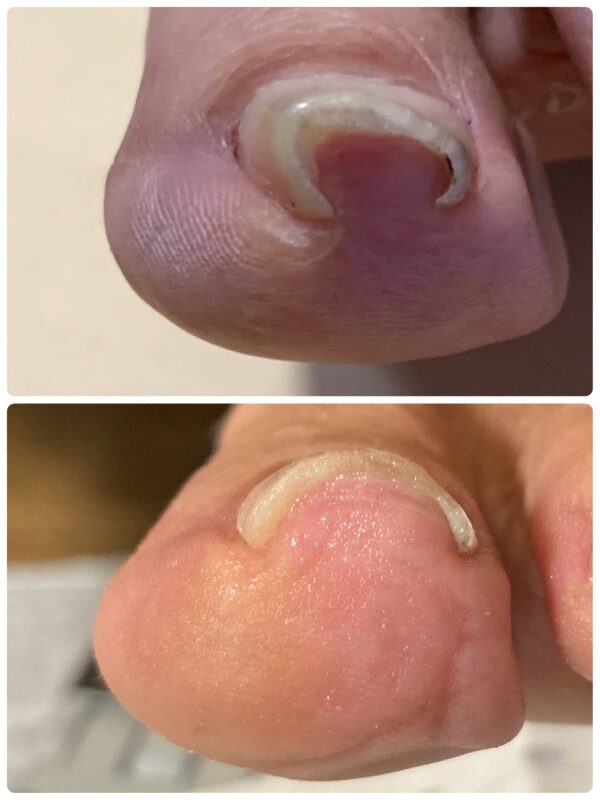 巻き爪ケア|症例画像